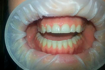 Dentadura de paciente