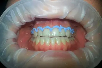 dentadura paciente antes